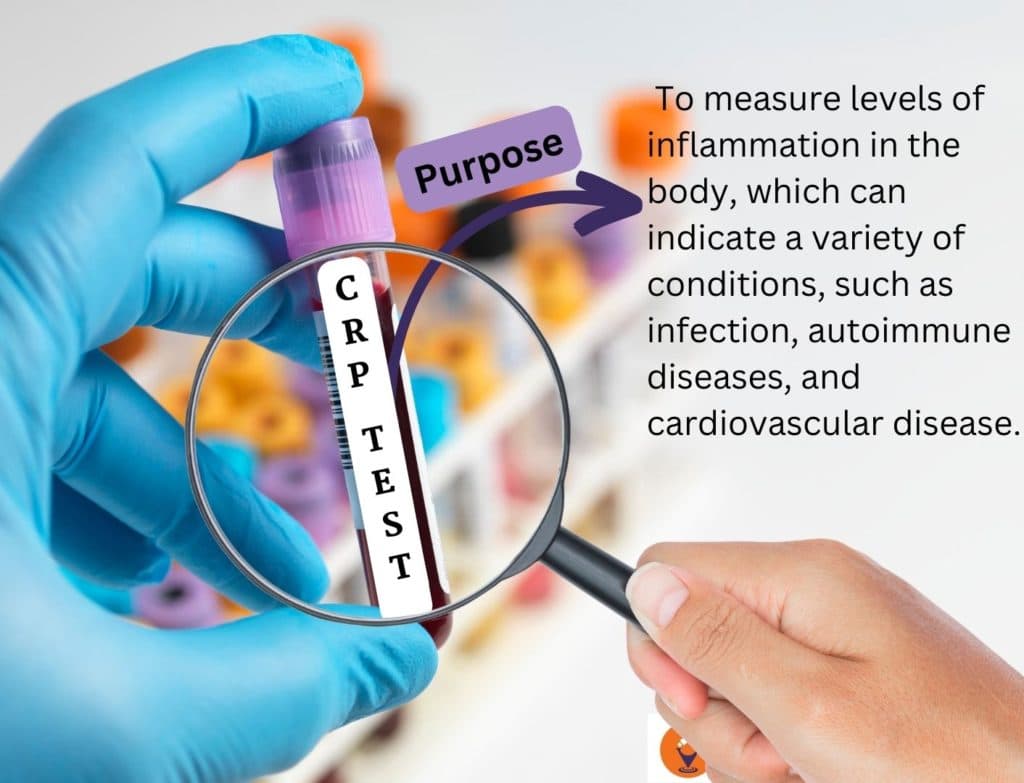 CRP Test: Price, Purpose, Sample Report & Normal Range [2026]