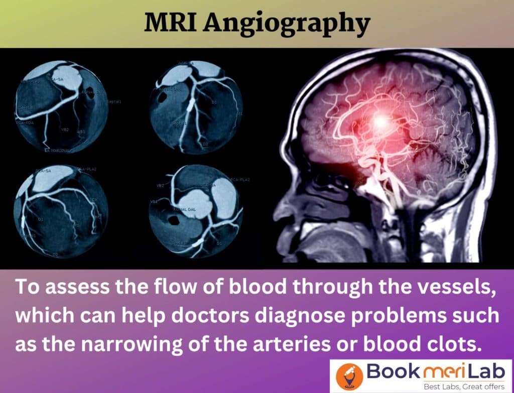 एमआरआई एंजियोग्राफी (MRI Angiography in Hindi)