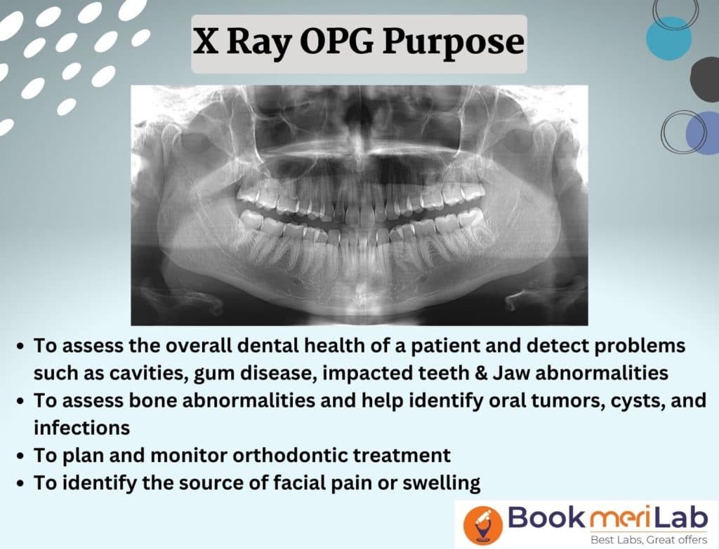 OPG X-Ray: Cost, Purpose, Results & Sample Report [2026]
