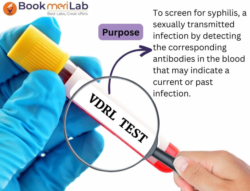 VDRL Test: Price, Purpose, Risks, Procedure & Result [2026]