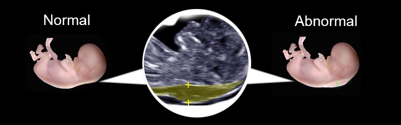 Pregnancy Ultrasound NT Scan : Normal Vs Abnormal results