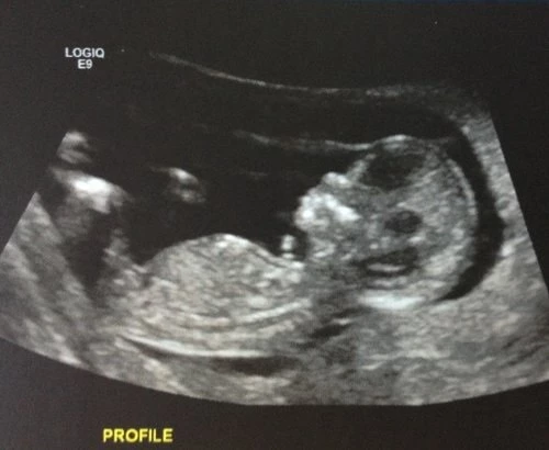 Ultrasound NT Scan test during pregnancy
