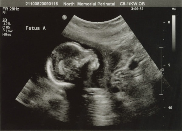 Anomaly Scan or Level 2 Ultrasound Picture