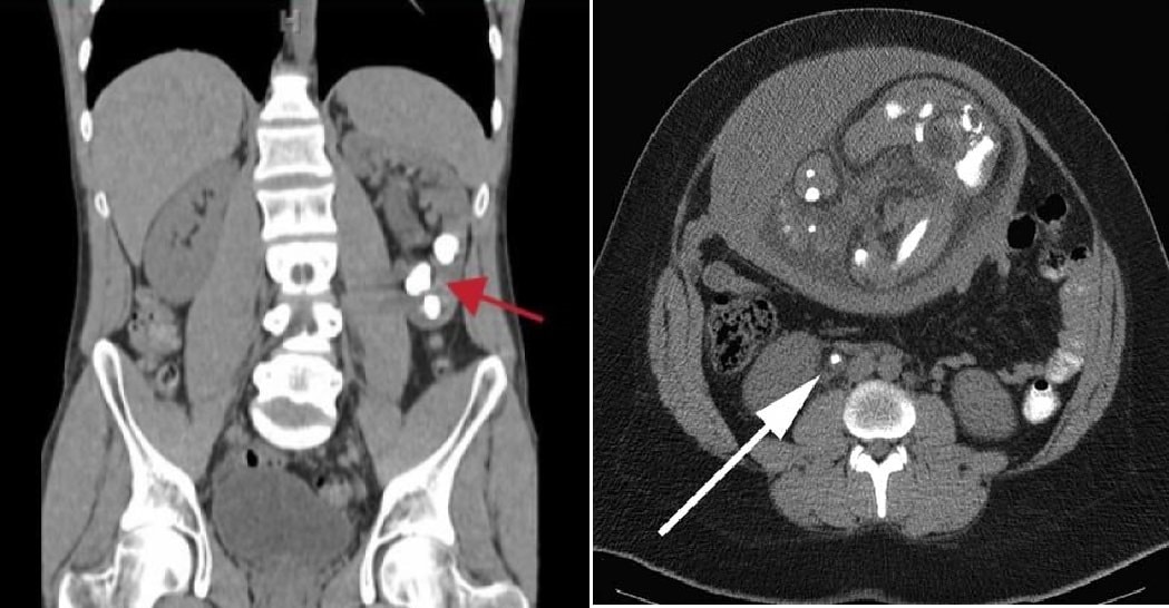 CT KUB Kidney Stone Image