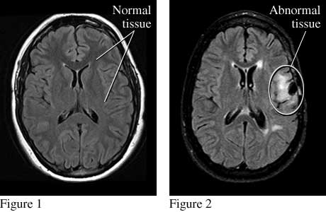 brain mri