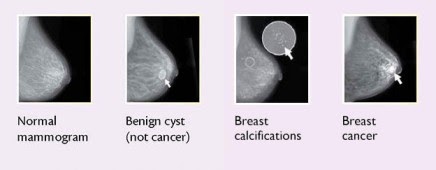 Common Breast Diseases (mammography)