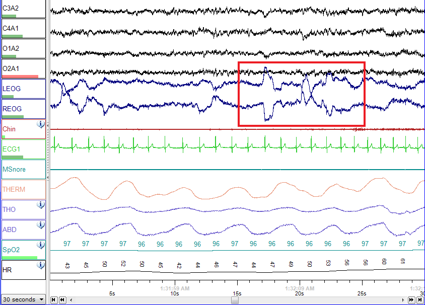  Sleep Study Report