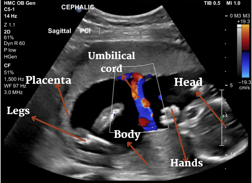 doppler pregnancy scan image