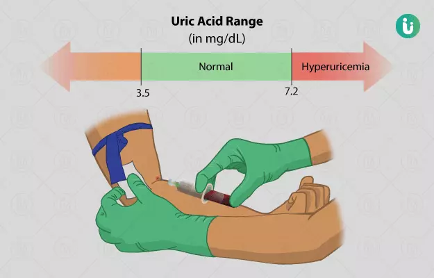 The result of Hyperuricemia. 