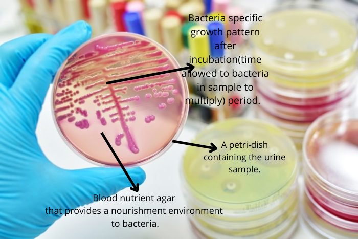 The Urine culture growth pattern result. 