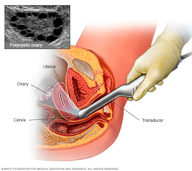 Transvaginal ultrasound sonography of a female.