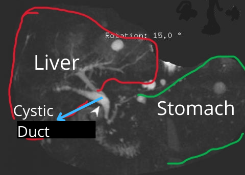 MRCP scan images