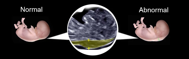 Ultrasound NT Scan Result