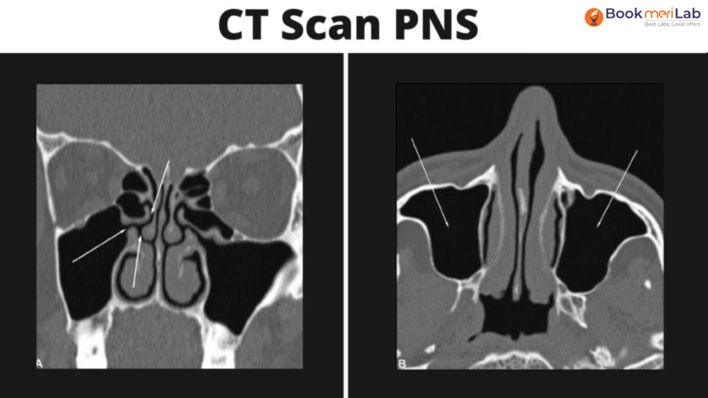 CT Scan PNS