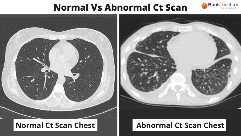 Normal Ct Scan Chest and Abnormal Ct Scan Chest.