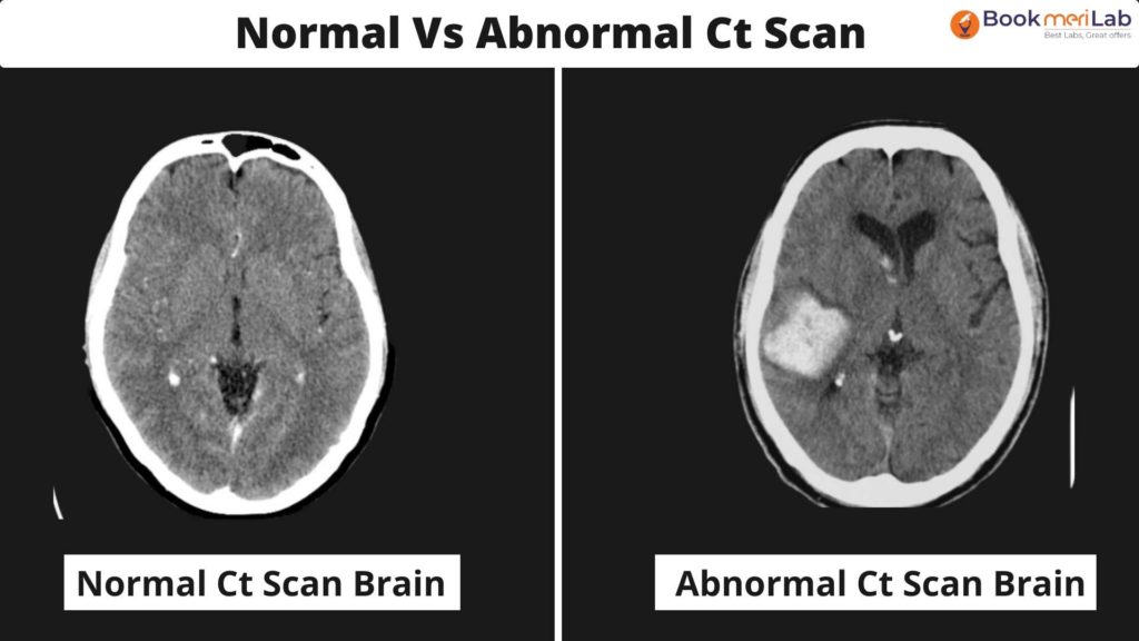 Normal CT brain results Vs Abnormal CT brain results 