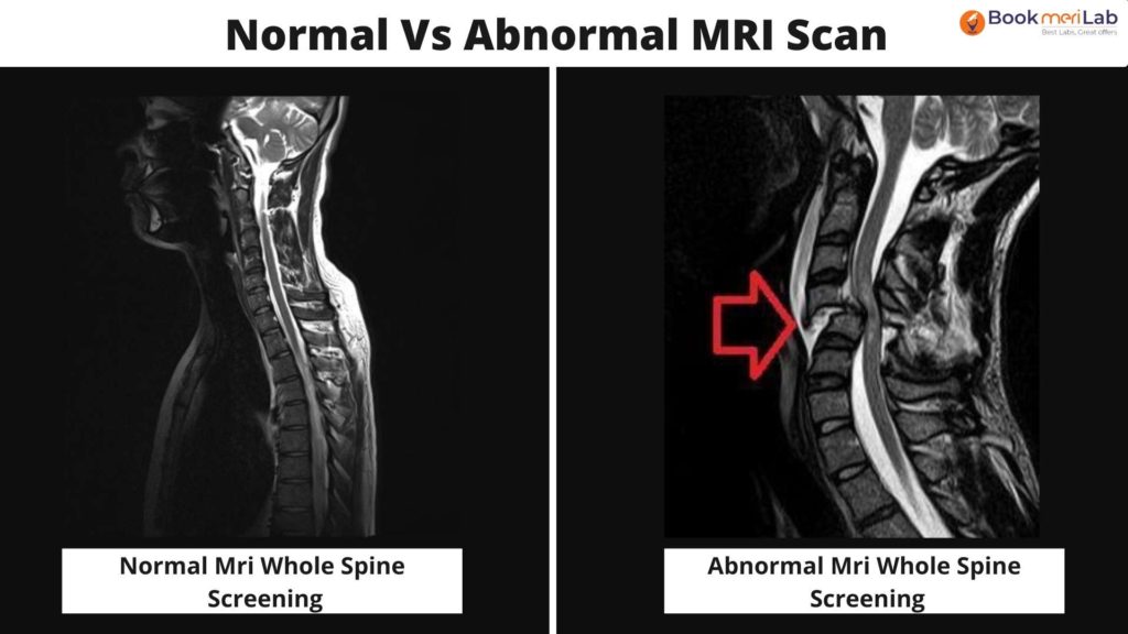 Normal vs Abnormal mri whole spine screening