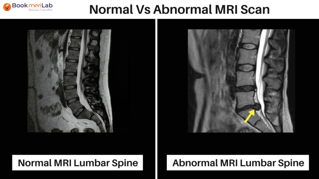 normal mri lumbar spine vs abnormal