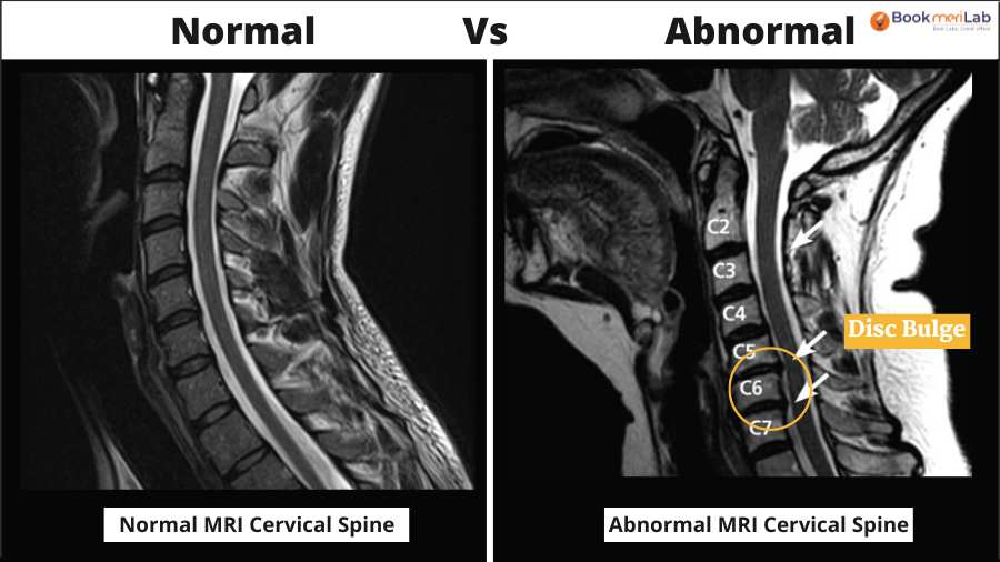 Normal vs abnormal mri cervical spine