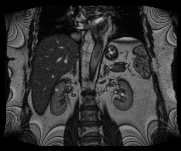 Normal Abdominal MRI