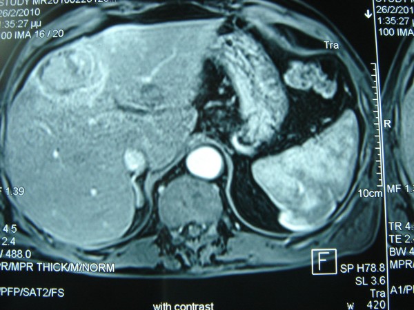 Abnormal MRI 