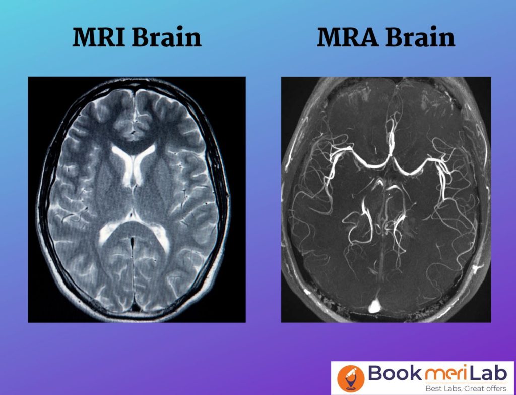 MRI Brain vs. MRA Brain