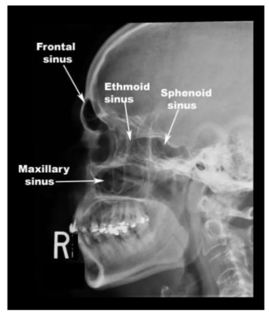 Paranasal sinuses lateral view