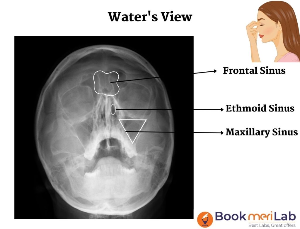 Water view or occipitomental view
