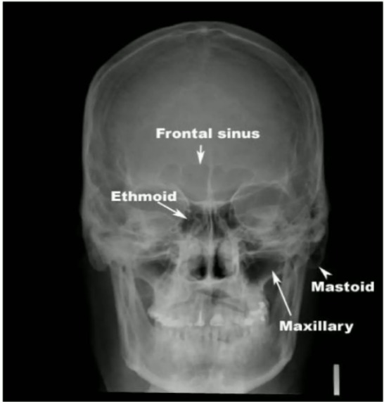 Cadwell’s view or occipital frontal view&nbsp;
