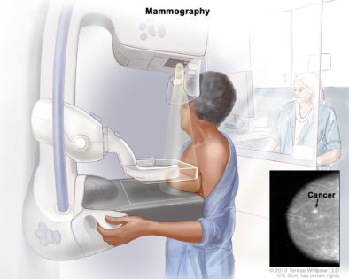 mammography test which representation of lump mass
