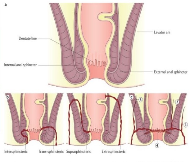 Anal fistula
