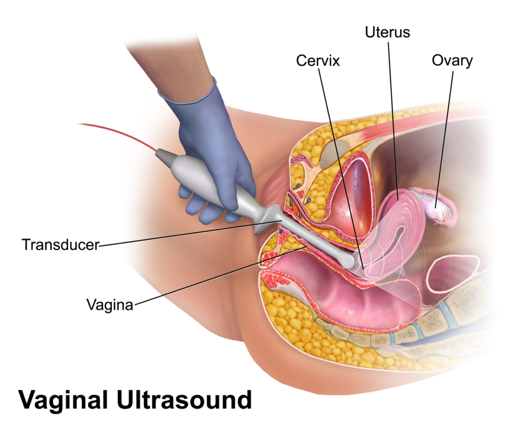 Transvaginal USG