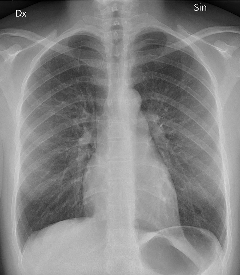 Posteroanterior (PA View)&nbsp;chest radiograph