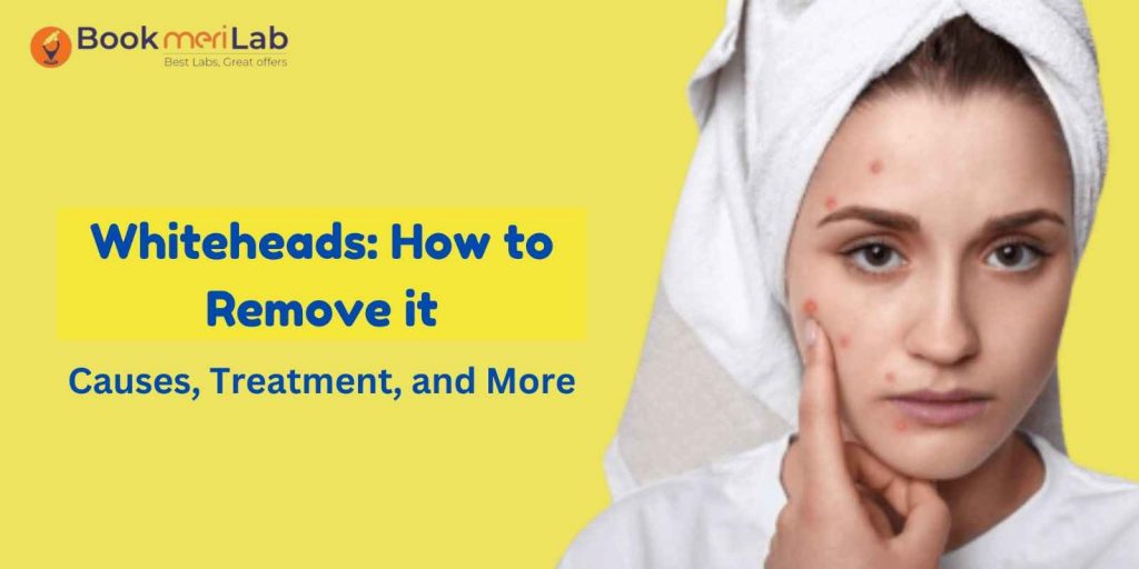 Whiteheads: How to Remove, Causes, Treatment, and More
