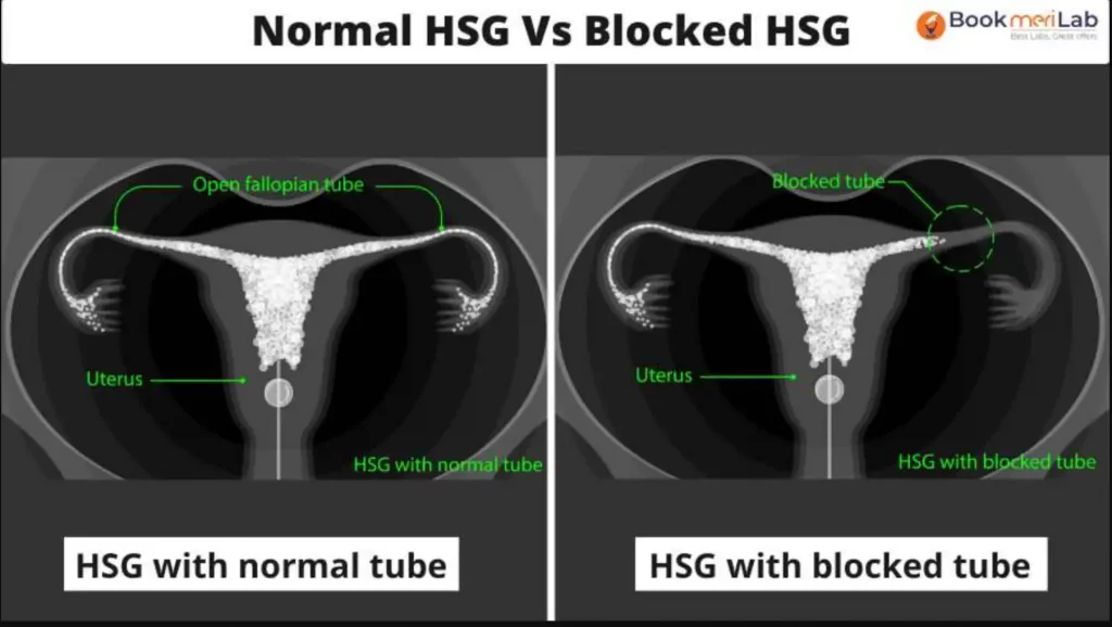 Normal HSG vs Blocked HSG